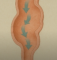 설사가 계속될 때