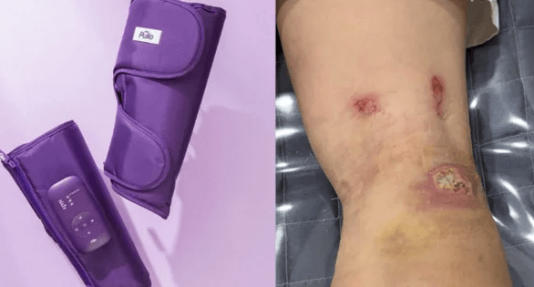 “저온 화상 흉터”… 치료비 달랬더니 풀리오의 답변은?