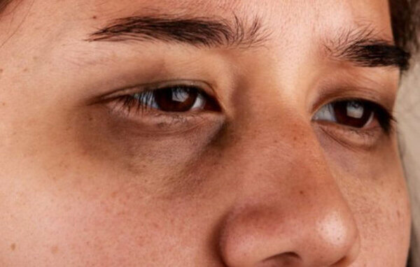 다크서클-심한경우-눈밑지방재배치수술-눈밑하안검수술