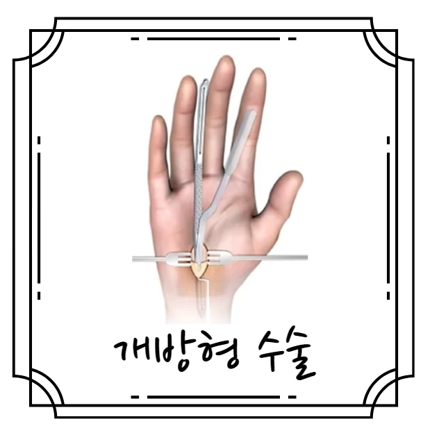 개방형 수술