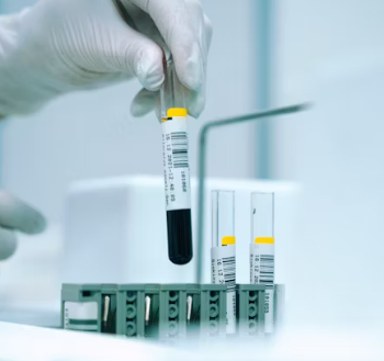 갑상성 기능 항진증 혈액검사 진단기준 치료법