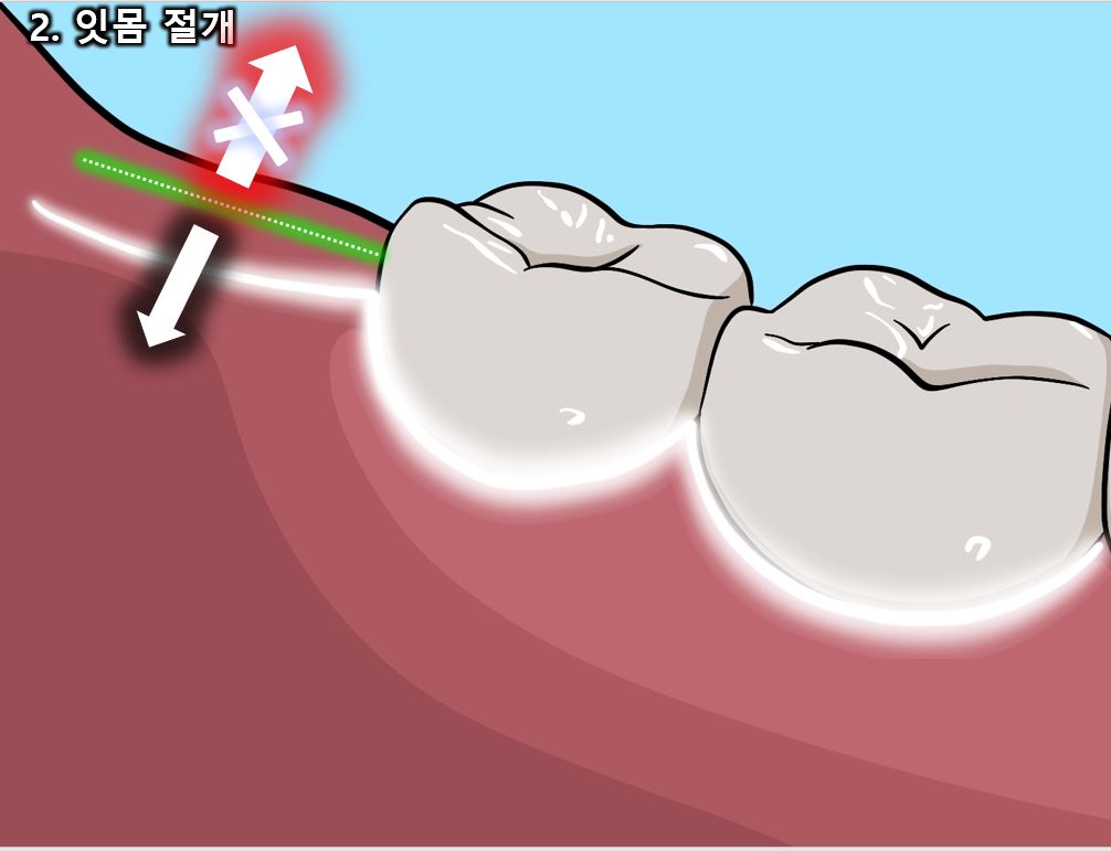사랑니 발치 과정과 통증, 신경 손상에 대한 모든 것