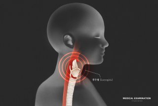 역류성 식도염이란?