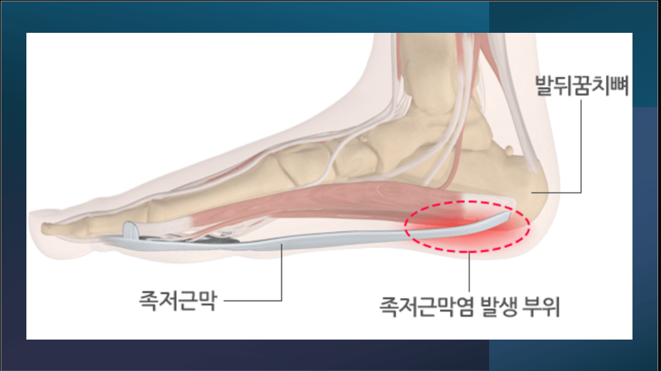 족저근막염: 아침 첫걸음이 통증이라면