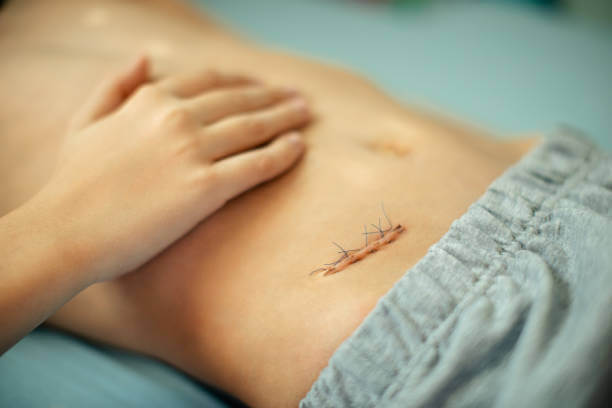 맹장 터지는 이유와 맹장염과 어떤 관계를 가지고 있는지도 알아봤습니다. 왜 맹장염이 파열로 이어질 수 있는 지와 맹장 벽이 왜 염증으로 약해지는지도 함께 읽어 보시기 바랍니다.