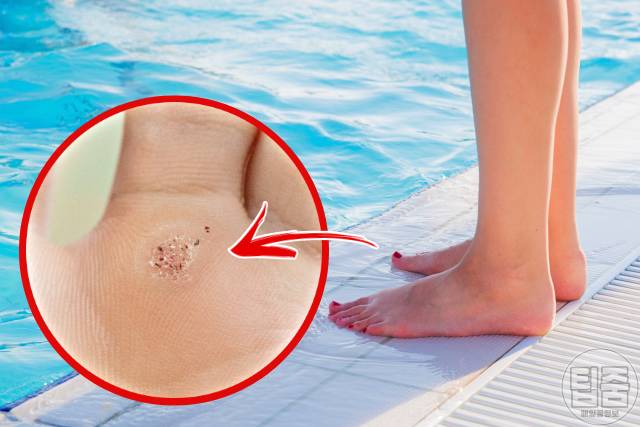 발바닥 사마귀 제거 연고