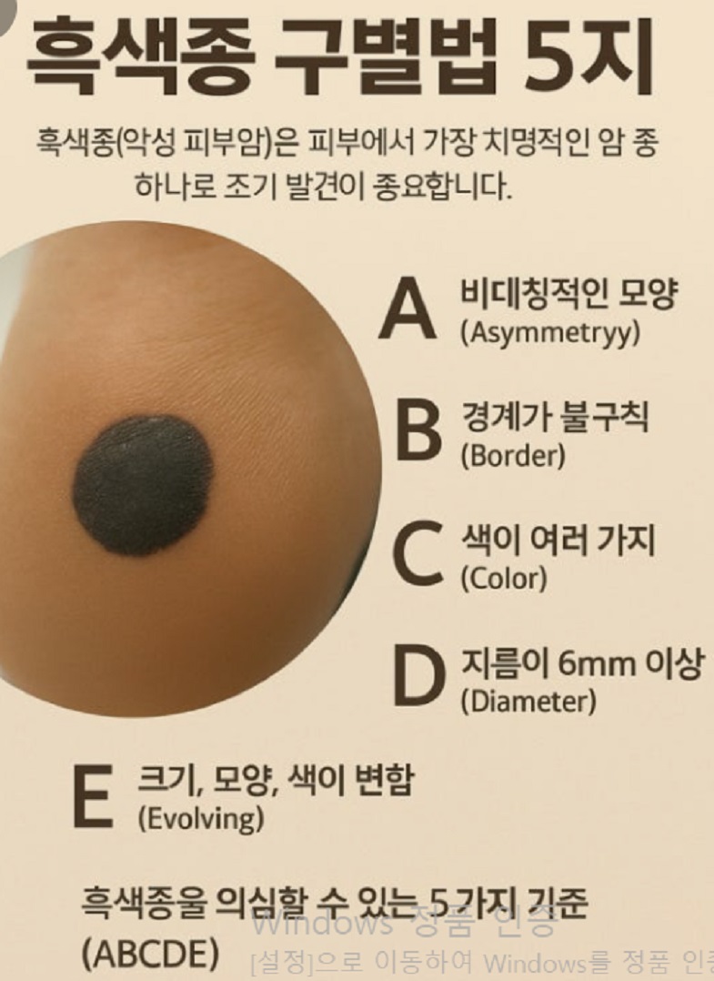 피부암-흑색종-점-비교