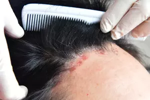 두피 지루성 피부염