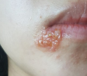 입술 포진(구순포진)