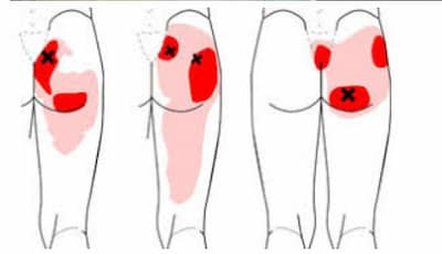 천골 통증 위치와 원인