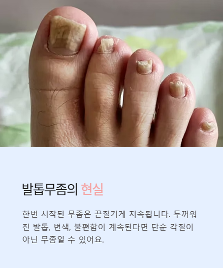 발톱무좀의 현실