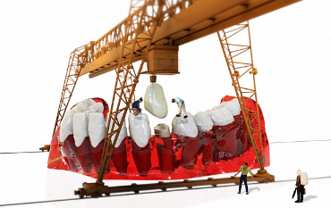 임플란트 식립 수술