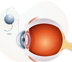 백내장 수술비용