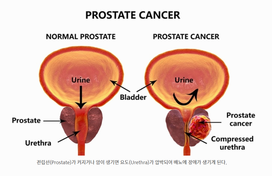 전립선암 초기 증상부터 진행 단계까지 꼭 알아야 할 체크리스트
