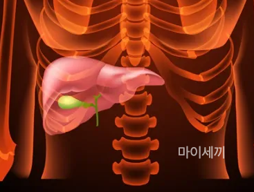 담낭용종 원인