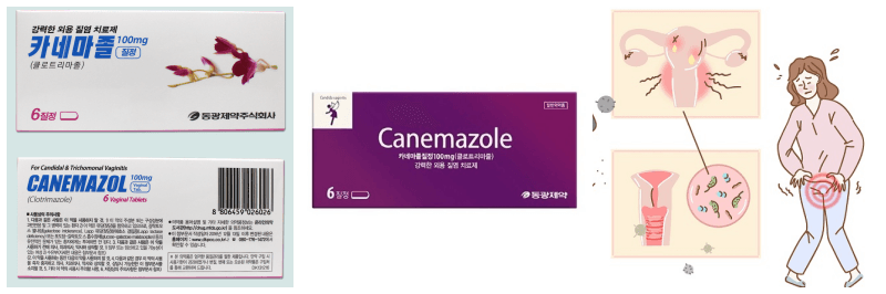 카네마졸, 질염 사진