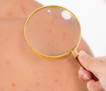 대상포진 초기증상