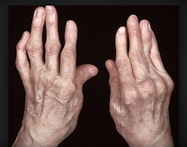 류마티스 관절염 손의 모습