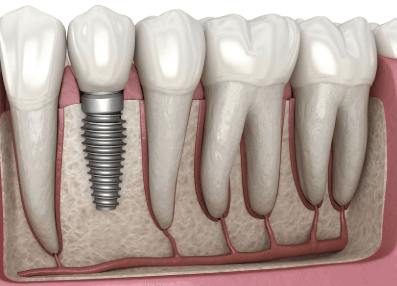 임플란트 회복기간