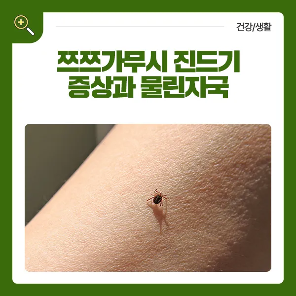 진드기 물린자국 대처법 참진드기 빨간 진드기 증상 확인_4
