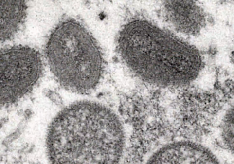 원숭이두창 바이러스 엠폭스(MPOX), 초기증상, 수포, 후유증, 치사율, 예방접종 등