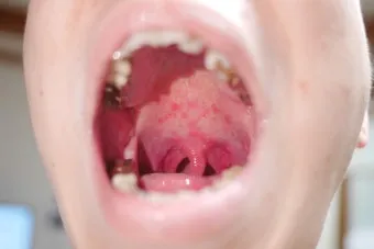 수족구 어른 전염에 대한 원인과 예방법 정리_3