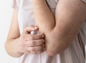 간경화 초기증상 25