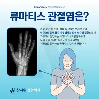 효과적인 류마티스 관절염 치료제 추천 약물 비교 가이드 2025 최신판_4