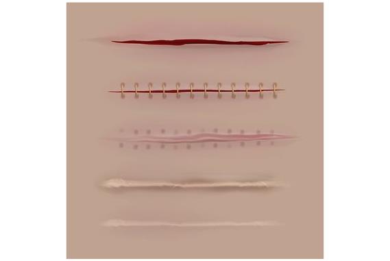 수술 상처 회복 단계