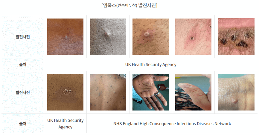 엠폭스-원숭이두창-발진-사진