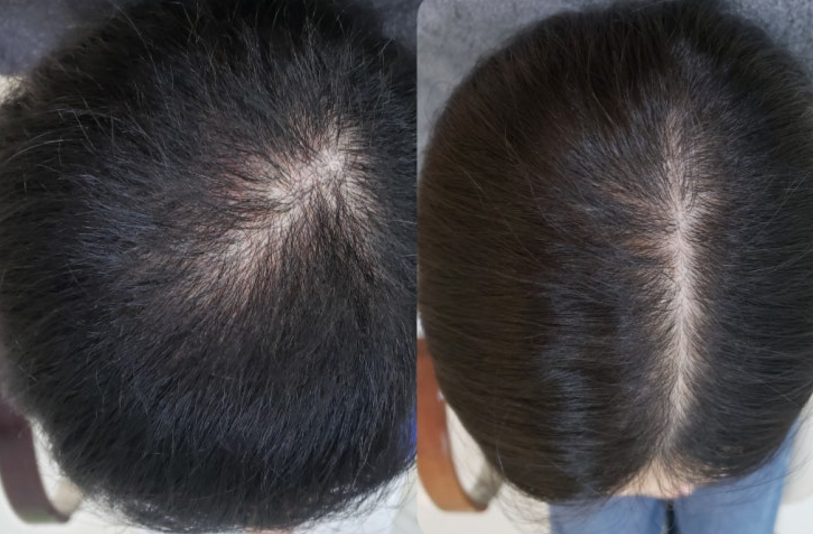 모발이식 3000모 비용 4000모 비용 부작용 과정