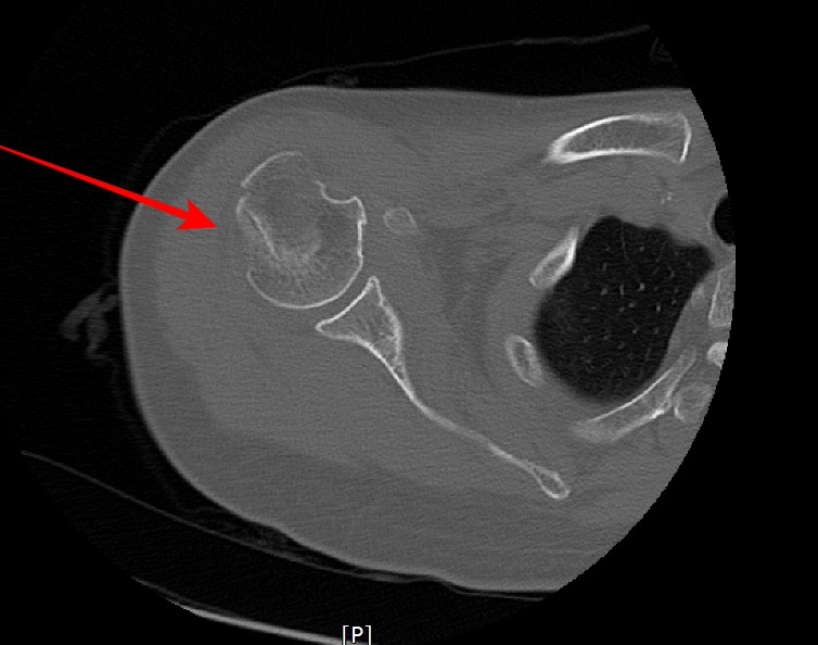 shoulder axial image