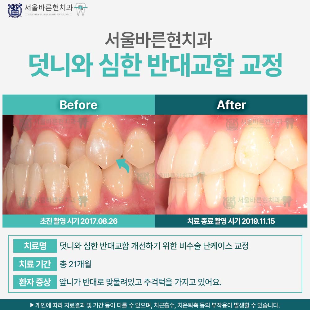 부산치아교정
