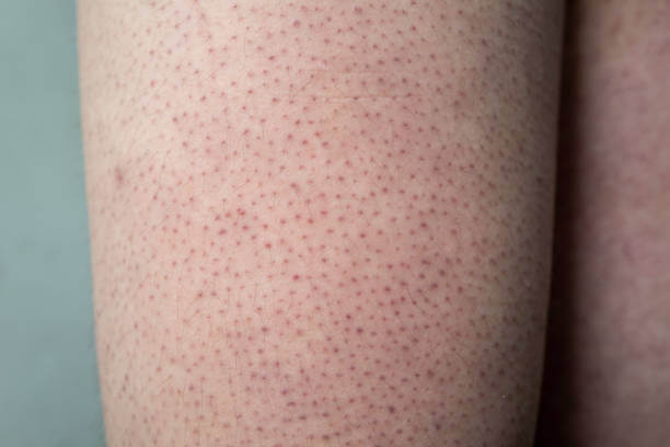 모공각화증 미스트 효과 있을까? 셀프 치료와 원인&amp;#44; 주요 증상들이 어떤 것들이 있는지 참고 하시기 바랍니다. 