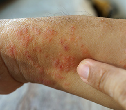 두드러기 원인 8가지 총정리 섬네일