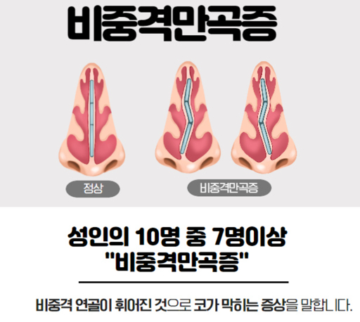 비중격 교정술 증상 및 진단 방법