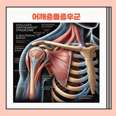 어깨충돌증후군수술