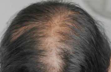 탈모의 원인과 해결방안