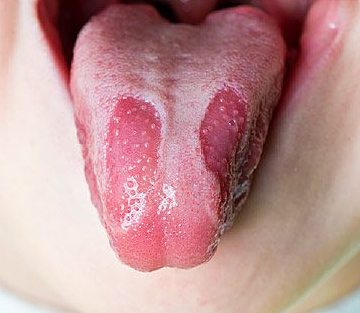 지도설(geographical tongue) 사진