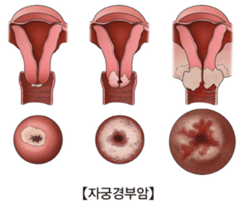 자궁경부암 증상 10가지 총정리 섬네일