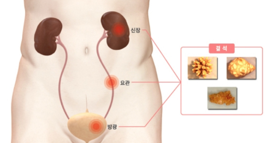 인체의 해부도 중에서 방광과 요관, 그리고 신장의 위치와 형태, 그리고 그 부위의 결석을 그린 그림 사진