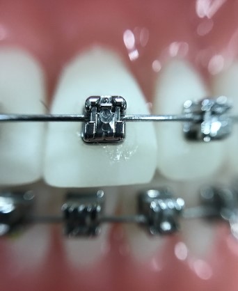 청소년의 치아 건강 적신호! 원인은 스마트폰?