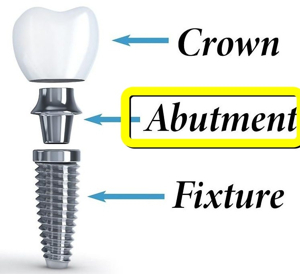 오스템임플란트 가격
