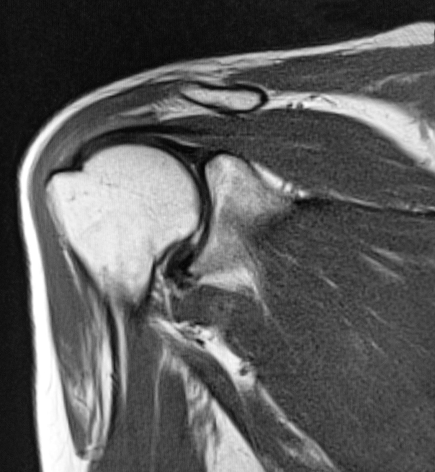 MRI: 회전근개 파열 및 연부 조직 손상 진단