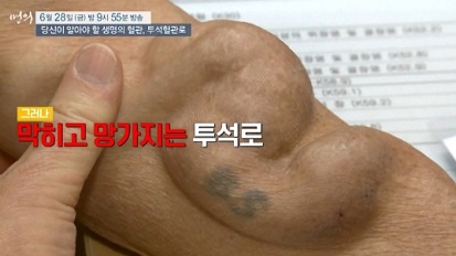 투석혈관로