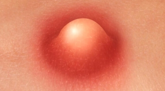 남자 사타구니 종기 치료법