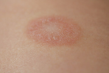 장미색 비강진 원인, 치료, 재발 등에 대해 알아봤습니다. 장미색 비강진은 pityriasis rosea이라고 불리는데요. 어떤 증상과 원인 치료가 있는지 꼼꼼히 읽어보세요!