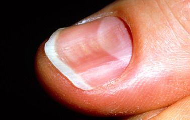 손톱 세로줄 무늬