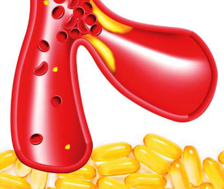 오메가3-연질-캡슐과-혈관-찌꺼기가-쌓이면서-혈행-흐름이-막힌-모습