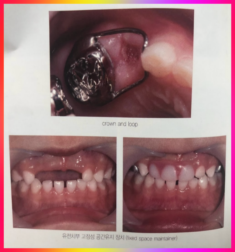 치아 공간 유지장치 끼운 모습